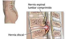 herniadisco