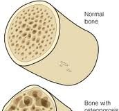 huesoosteoporosis