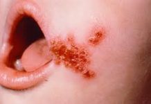 impetigo