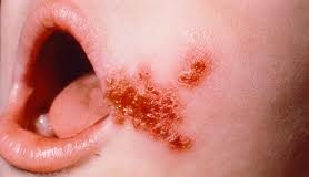 impetigo