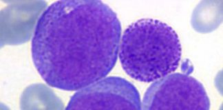 leucemiamieloide_cronica