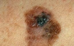 melanomass