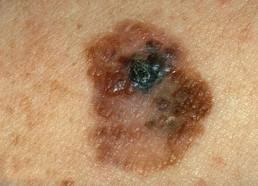 El melanoma aumenta un 7% al año en España melanomass