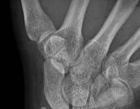 osteonecrosis