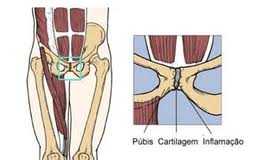 pubalgia