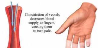 sindrome-raynaud