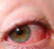 uveitis
