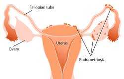 Endometriosis