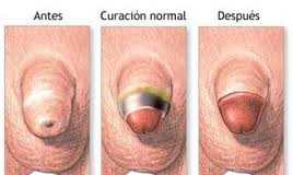 En qué consiste la fimosis y cómo tratarla Fimosis