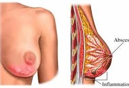 Mastitis