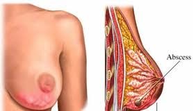 Mastitis