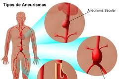 aneurisma