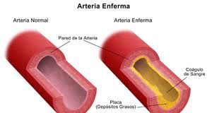 arteriosclerosis