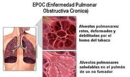 epoc1