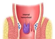 hemorroides