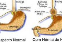 Hernia de hiato herniahiatos