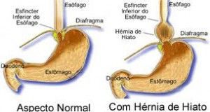 herniahiatos