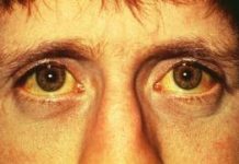 Una coloración distinta: Ictericia images2
