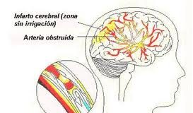 infartocerebral