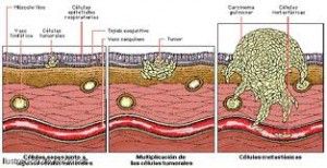 metastasis