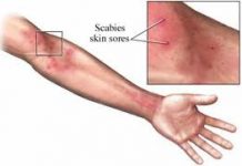 Escabiosis o Sarna sarna
