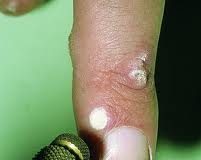 verrugacrioterapia