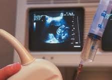 Amniocentesis