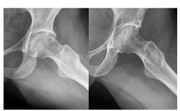 Choque-femoro-acetabular
