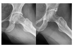 Choque-femoro-acetabular