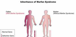 Marfansindrome