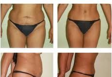 adominoplastia