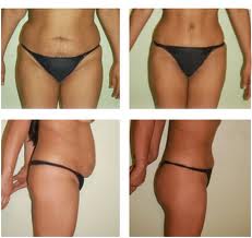 adominoplastia