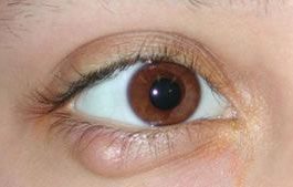 chalazion