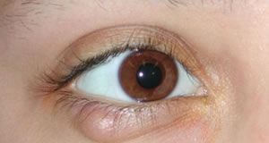 chalazion