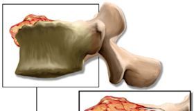 osteosarcoma1