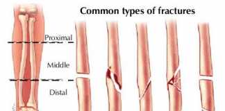 Fracturas2