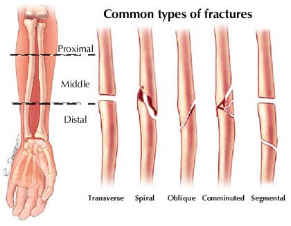Fracturas2