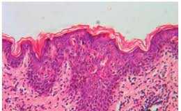 La-esclerosis-de-liquen