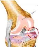 anquilosis