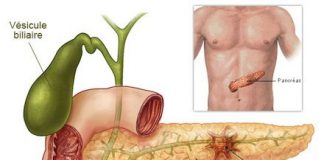 cancer-de-pancreas1