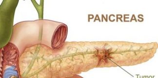 cancerpancreas1