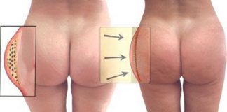 lipotransferencia-glutea