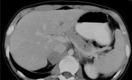 El-tumor-feocromocitoma