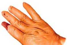 Esclerodermia