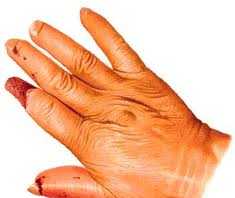 Esclerodermia