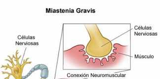 Miastenia-gravis1