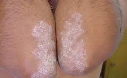 curarpsoriasis