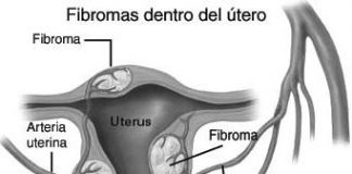 fibromas-dentro-del-utero1