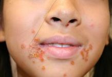 impetigo-2