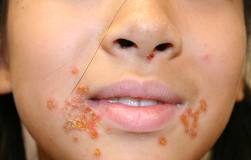 impetigo-2